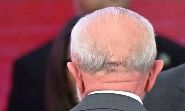 LULA PASSA POR CIRURGIA DE EMERGÊNCIA APÓS SOFRER HEMORRAGIA INTRACRANIANA