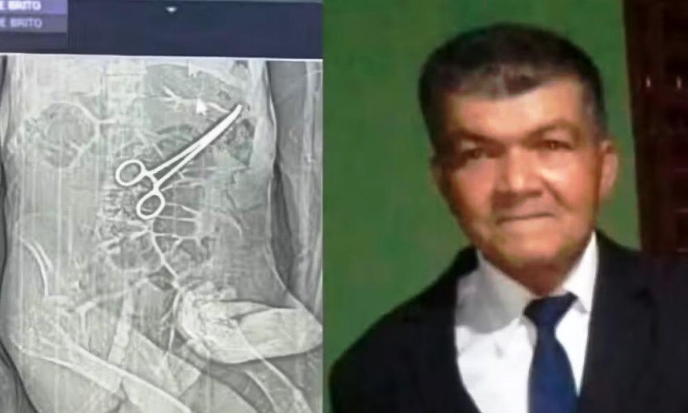 PINÇA ESQUECIDA NO ABDÔMEN DE IDOSO PODE TER CAUSADO SUA MORTE